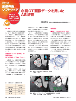 心臓CT画像データを用いた AS評価